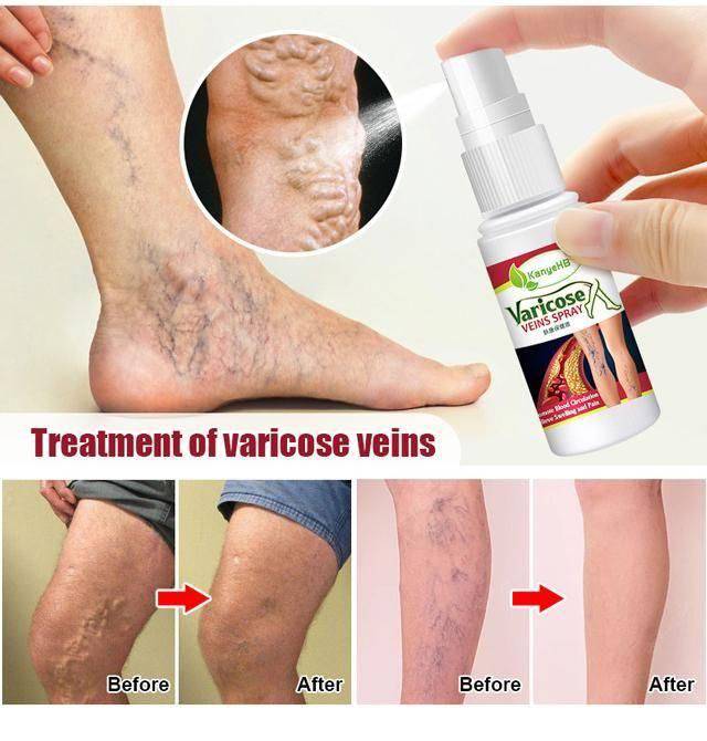 Varicose Veins Treatment Spray - D N A Fitness&Beauty