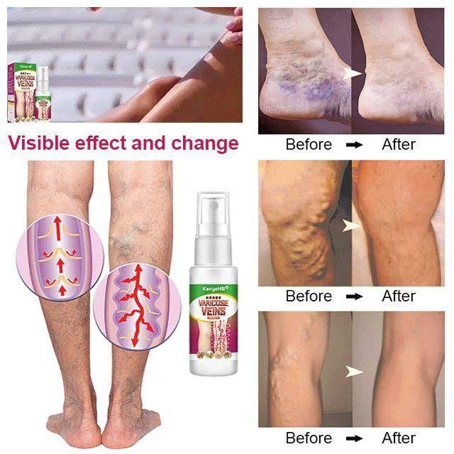 Varicose Veins Treatment Spray - D N A Fitness&Beauty