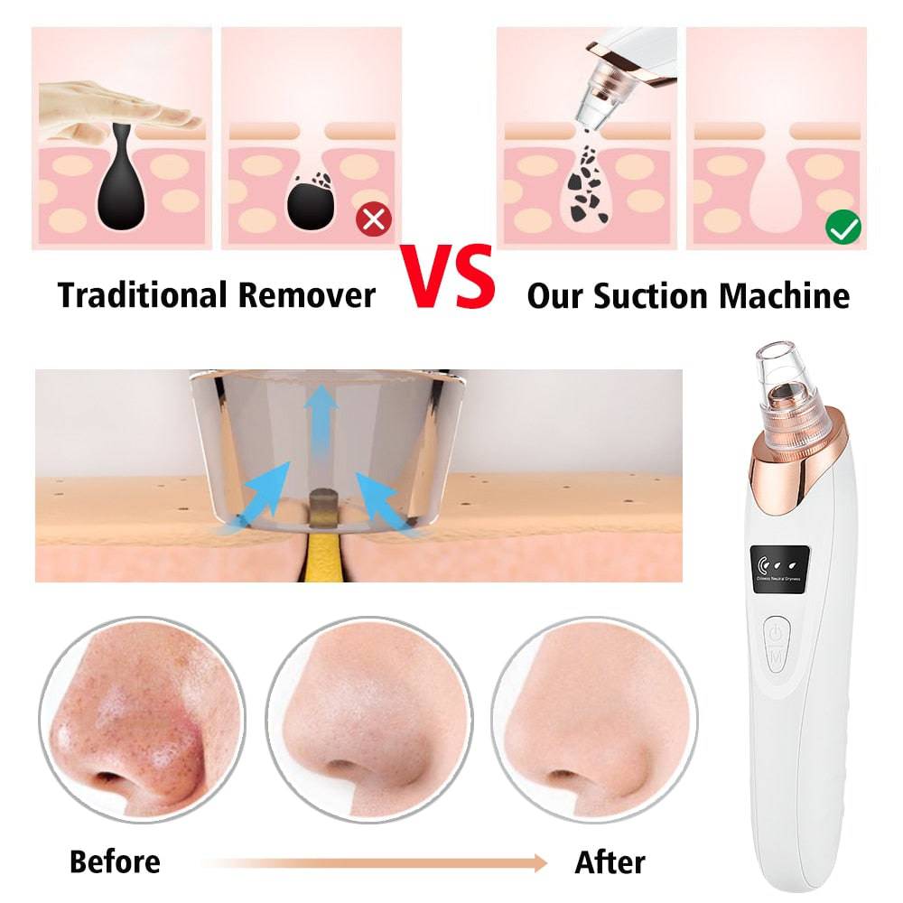 Beauty Electric Blackhead Remover - D N A Fitness&Beauty