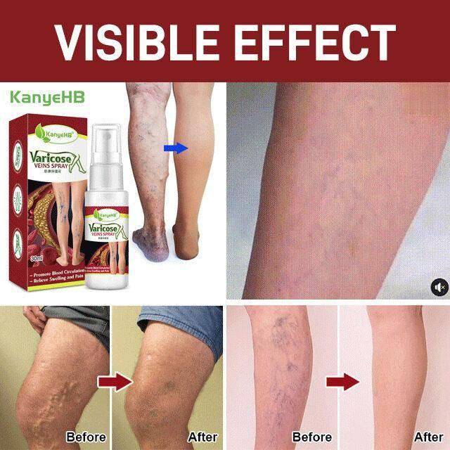 Varicose Veins Treatment Spray - D N A Fitness&Beauty